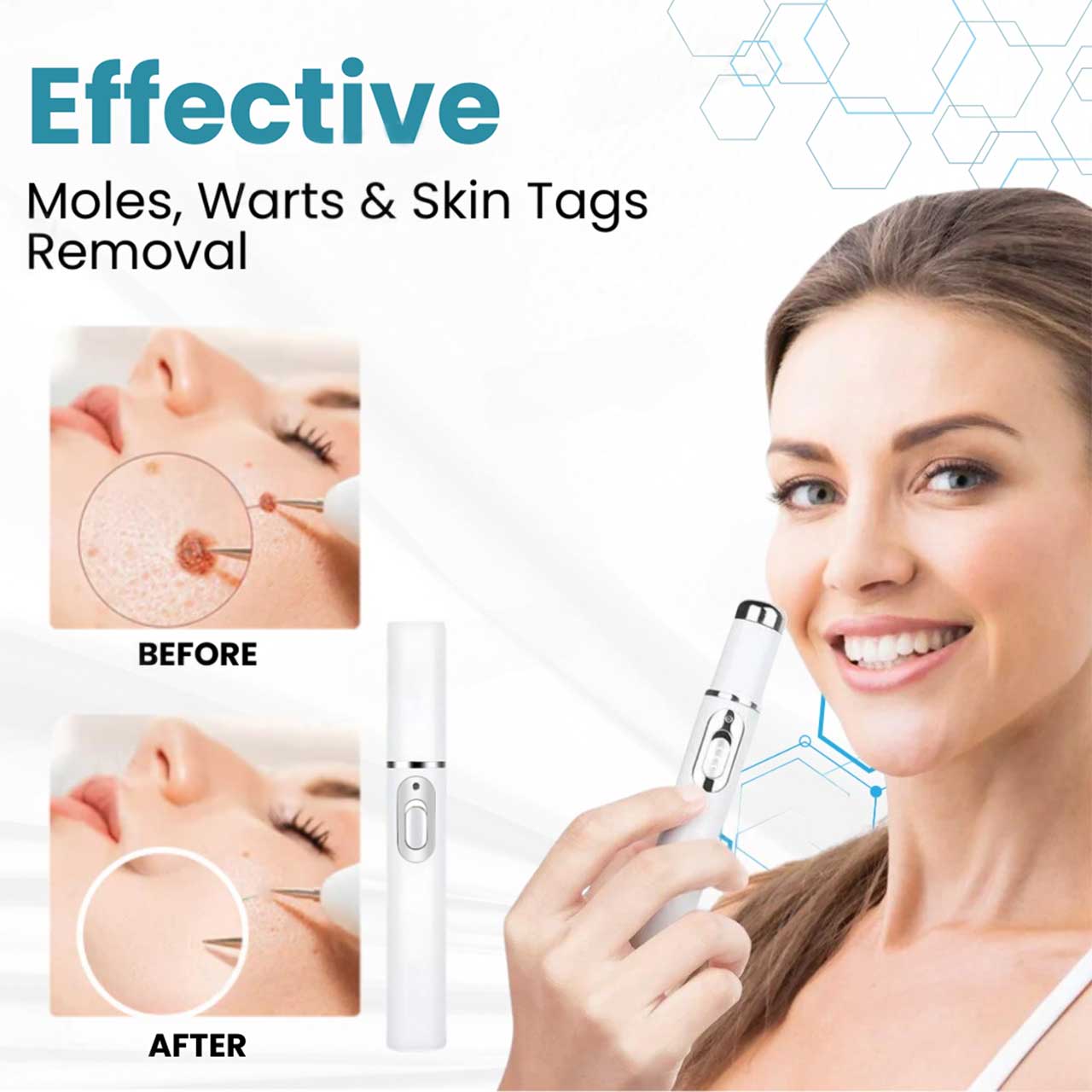 Lovilds® Non-Invasive Mole and Wart Removal Laser Pen(⏰Limited Time Discount⏰)