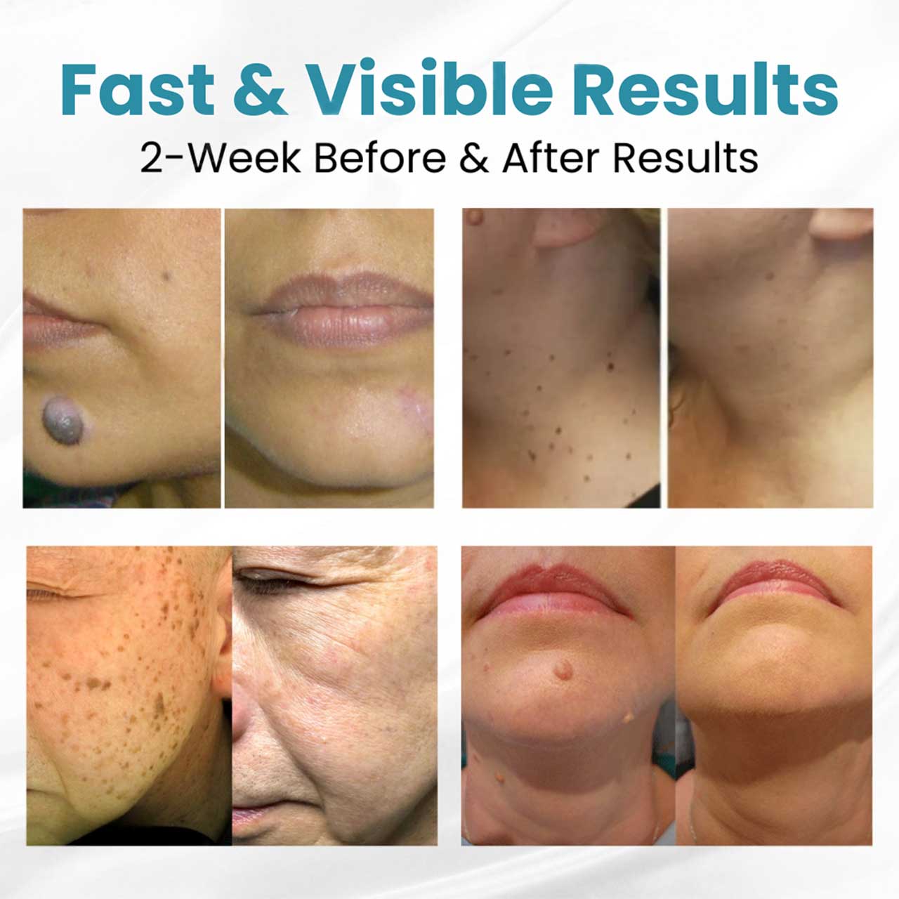 Lovilds® Non-Invasive Mole and Wart Removal Laser Pen(⏰Limited Time Discount⏰)