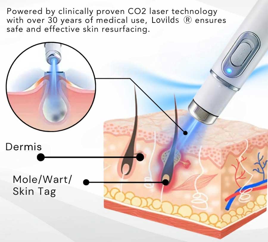 Lovilds® Non-Invasive Mole and Wart Removal Laser Pen(⏰Limited Time Discount⏰)