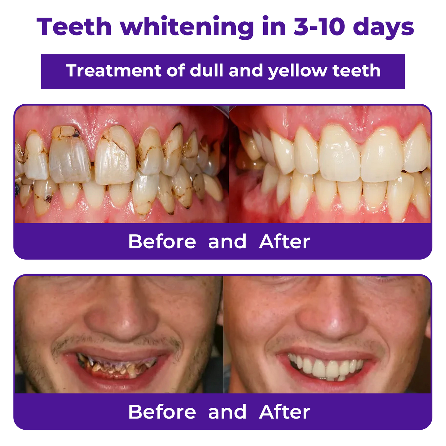 🦷LOVILDS™ Dental Repair Mineral Powder >> 🔥Buy 1 Get 1 Free🔥